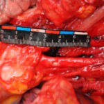 Murdered young woman with knife in pussy + autopsy