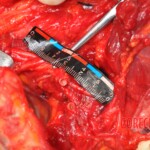 Murdered young woman with knife in pussy + autopsy