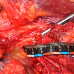 Murdered young woman with knife in pussy + autopsy