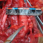 Murdered young woman with knife in pussy + autopsy