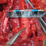 Murdered young woman with knife in pussy + autopsy