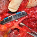 Murdered young woman with knife in pussy + autopsy