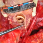 Murdered young woman with knife in pussy + autopsy