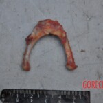 Murdered young woman with knife in pussy + autopsy