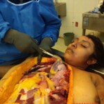 Autopsy of woman