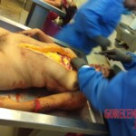 Autopsy of woman