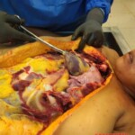 Autopsy of woman