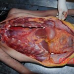 Autopsy of woman