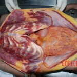 Autopsy of woman