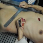 Autopsy of stabbed girl