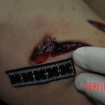 Autopsy of stabbed girl