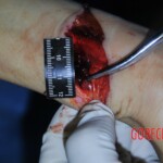 Autopsy of stabbed girl