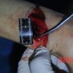 Autopsy of stabbed girl