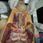 Autopsy of stabbed girl