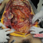 Autopsy of stabbed girl