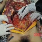 Autopsy of stabbed girl