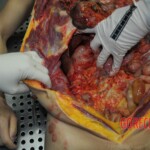 Autopsy of stabbed girl