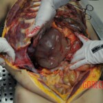 Autopsy of stabbed girl