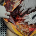 Autopsy of stabbed girl