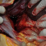 Autopsy of stabbed girl