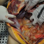 Autopsy of stabbed girl