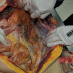 Autopsy of stabbed girl