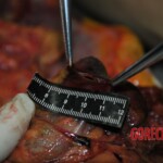 Autopsy of stabbed girl