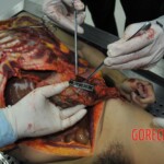 Autopsy of stabbed girl