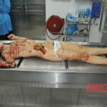 Autopsy of stabbed girl