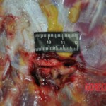 Autopsy of stabbed girl