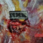 Autopsy of stabbed girl