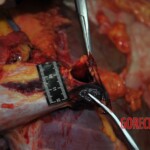 Autopsy of stabbed girl