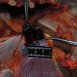 Autopsy of stabbed girl