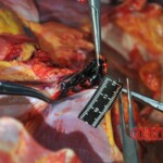 Autopsy of stabbed girl