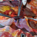 Autopsy of stabbed girl