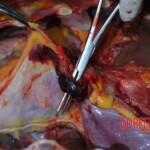 Autopsy of stabbed girl