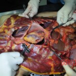 Autopsy of stabbed girl