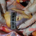 Autopsy of stabbed girl