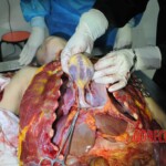 Autopsy of stabbed girl