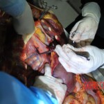 Autopsy of stabbed girl