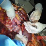 Autopsy of stabbed girl