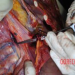 Autopsy of stabbed girl