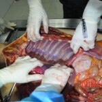 Autopsy of stabbed girl