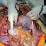 Autopsy of stabbed girl