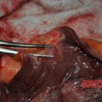 Autopsy of stabbed girl