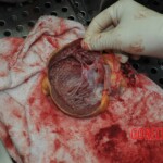 Autopsy of stabbed girl