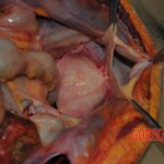 Autopsy of stabbed girl