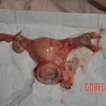 Autopsy of stabbed girl