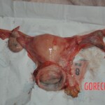 Autopsy of stabbed girl