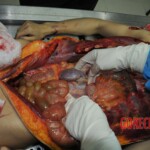 Autopsy of stabbed girl
